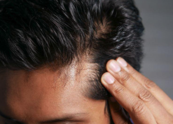 탈모 치료 및 억제제의 장점